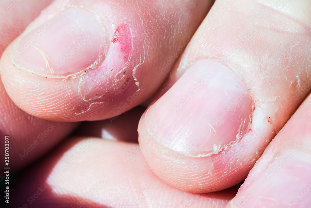 Fototapeta premium Bitten skin on the fingers