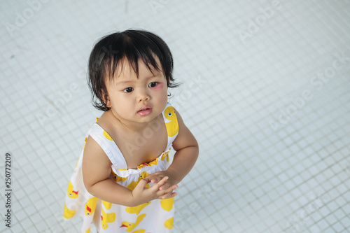 Closeup little girl with swollen eye from insect bite with red bruise on white tiled floor background
