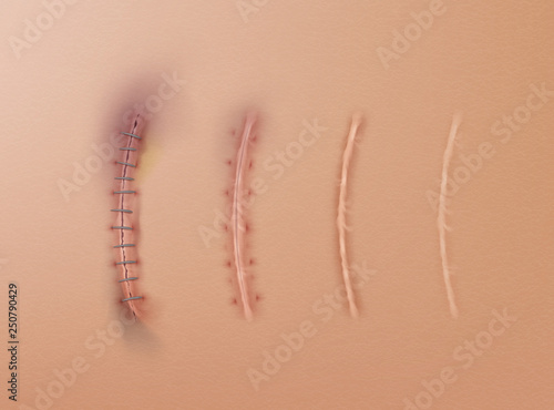 Surgical sutures different stages