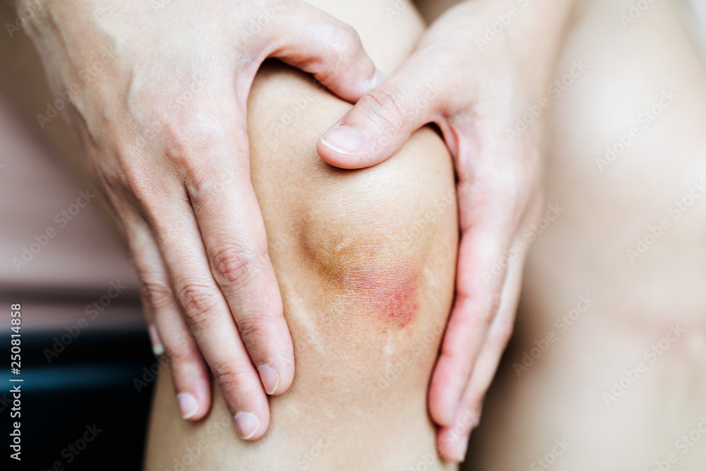 bruised knee of asia woman, selective focus bruised knee of asia woman, selective focus