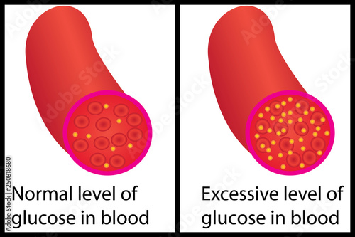 Normal and excessive level of blood sugar glucose control 