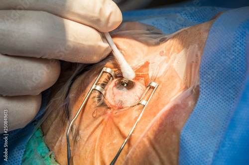 cataract eye surgery