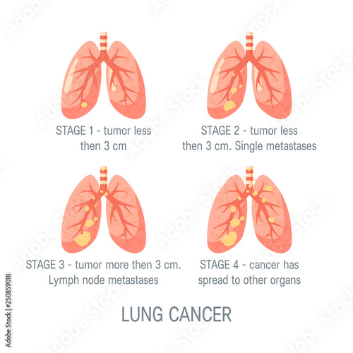 Lung cancer vector concept in flat style