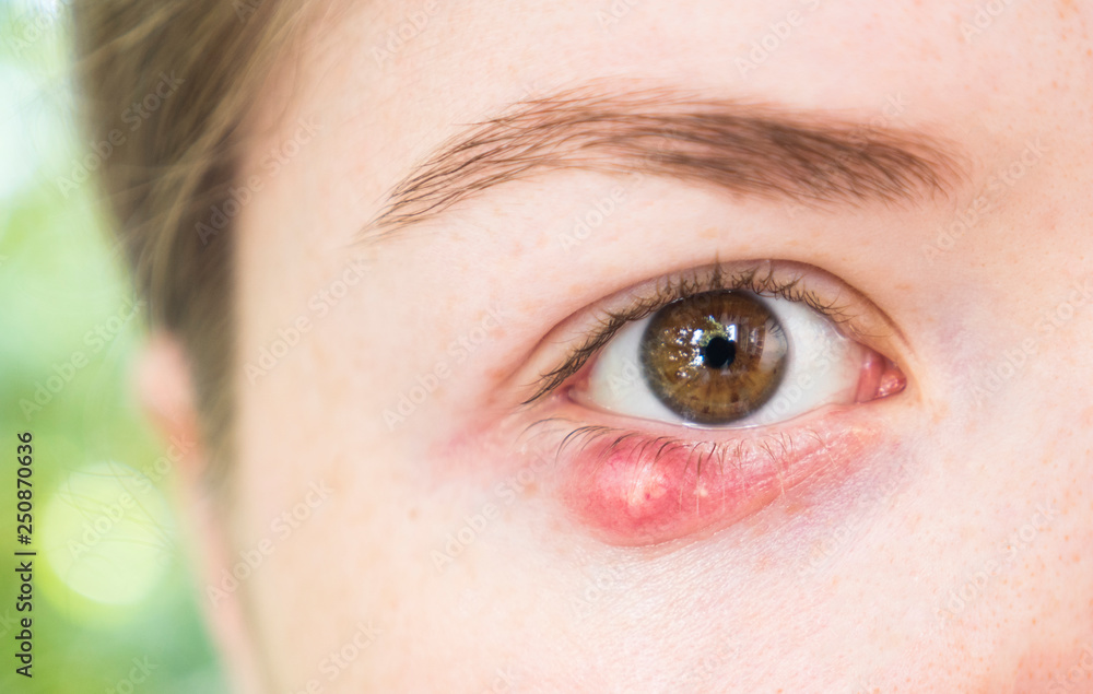Fototapeta premium Eyelid abscess. Close up photo of young caucasian woman barley brown eye infection, eyelid abscess, stye, hordeolum. Concept of health, disease and treatment.