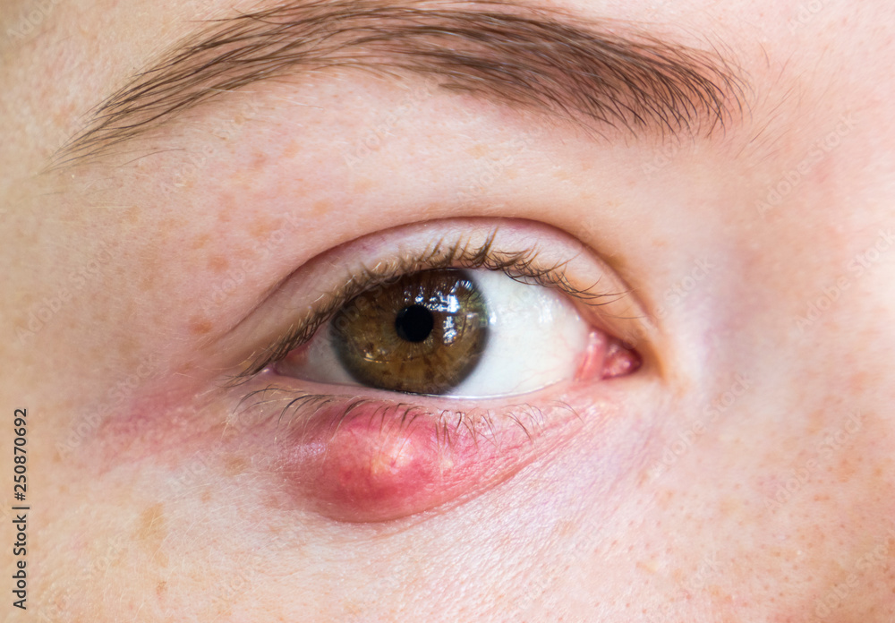 Eyelid Abscess Close Up Photo Of Young Caucasian Woman Barley Brown Eye Infection Eyelid 