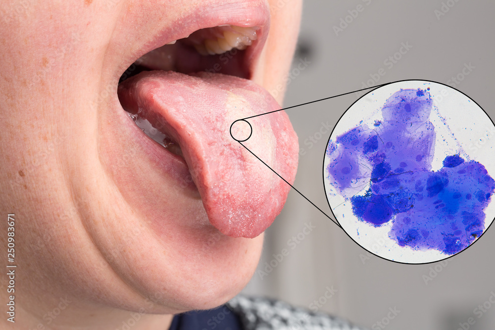 Oral trush on woman tongue with microscope view - obrazy, fototapety, plakaty 