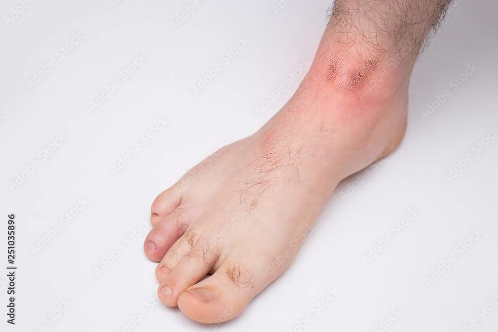 nøgle Scan vindue Red spots on on the skin of men's feet. The cause is winter cold and wind  conditions. Light grey background Stock Photo | Adobe Stock