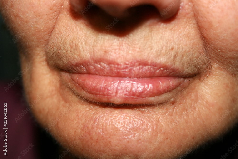 Wrinkles on the lips and chin. Nasolabial folds. Fluff mustache. Wrinkles on the lips and chin. Nasolabial folds. Fluff mustache.