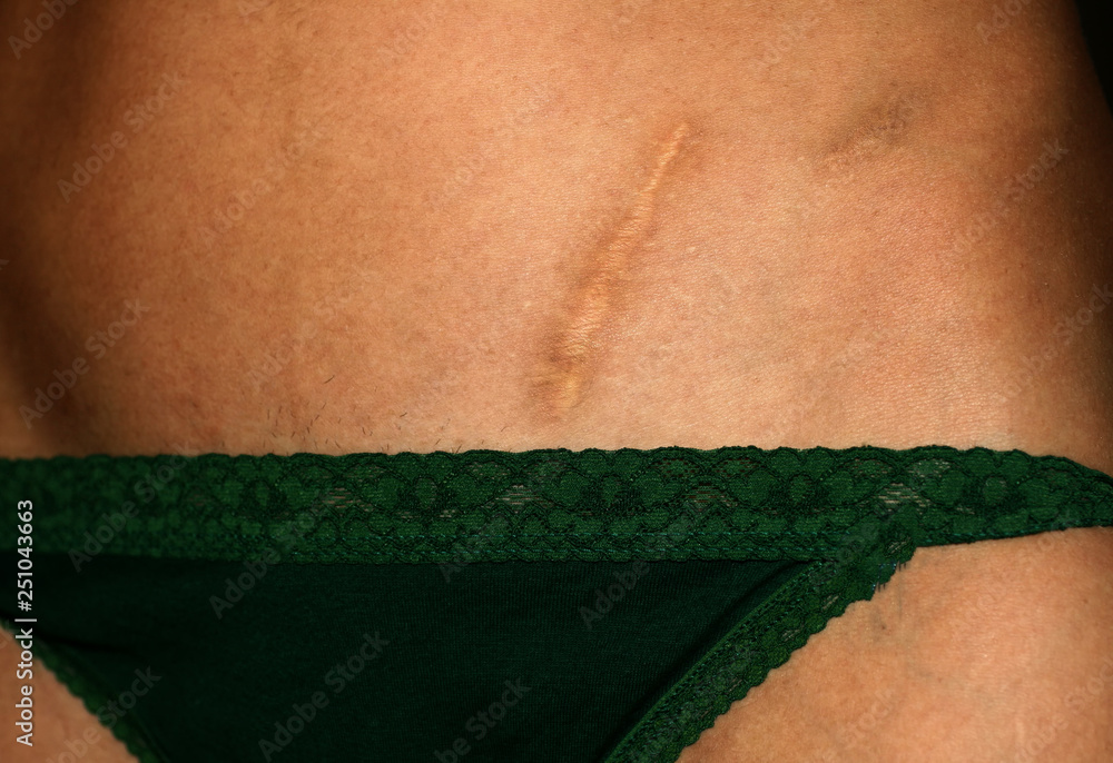 Scar on abdomen from operation of appendicitis. appendectomy scar
