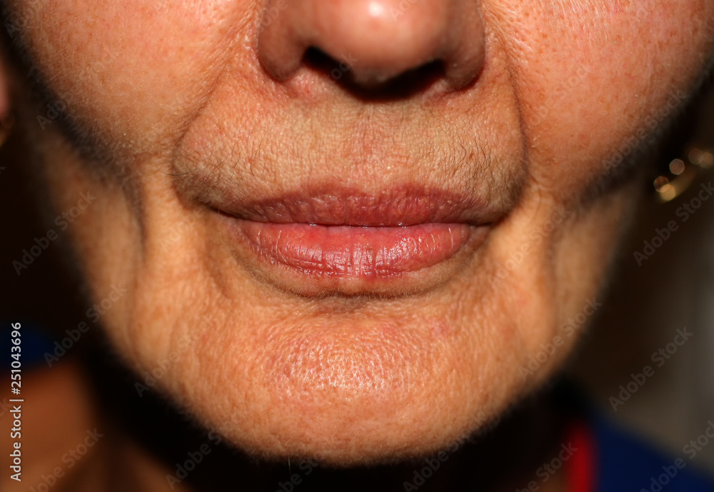 Sunken cheeks. Nasolabial folds on face. Wrinkles. Sunken cheeks. Nasolabial folds on face. Wrinkles.