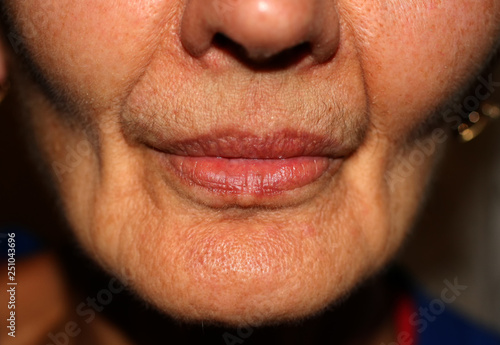 Sunken cheeks. Nasolabial folds on face. Wrinkles.