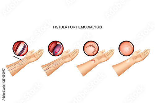 fistula for hemodialysis. suturing of vein and artery photo