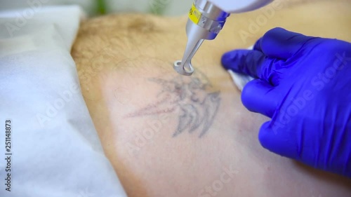 Wallpaper Mural Cosmetologist doctor removes tattoo patient man professional laser. Laser cosmetology Torontodigital.ca