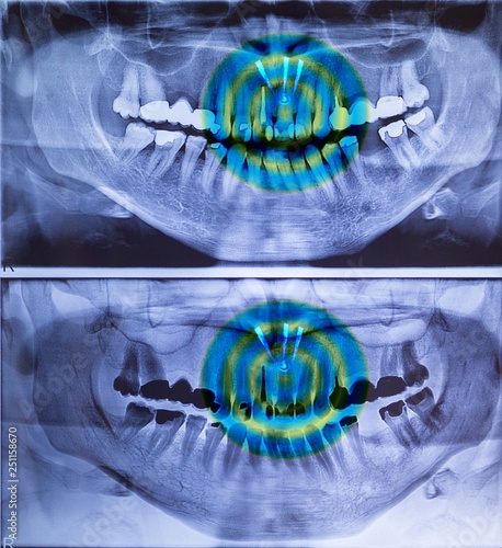 Panoramic dental X-ray picture in 2 versions with pain image of the frond teeth.