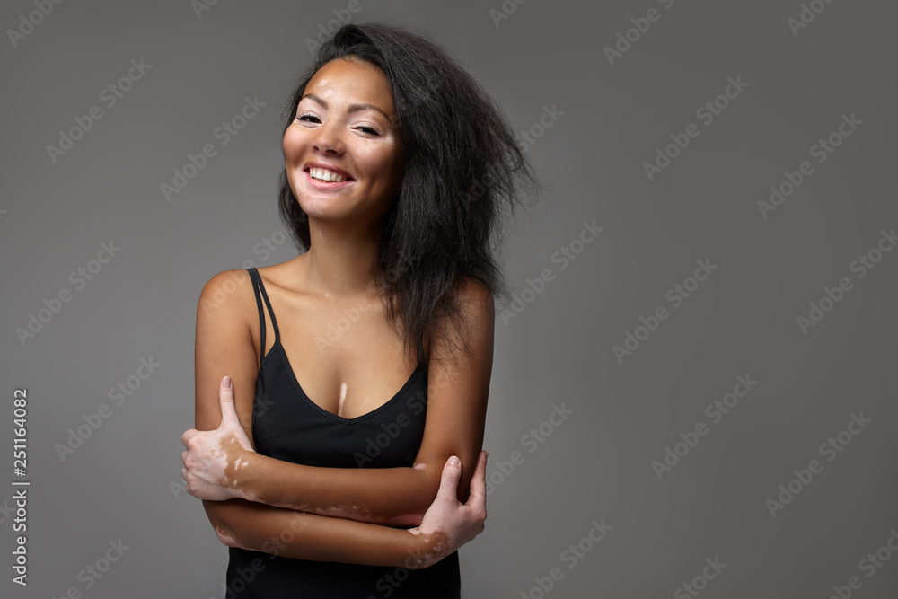 Obraz premium Beautiful African girl in studio with skin problems Vitiligo studio shooting