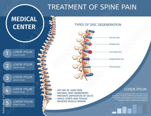 Treatment of Spine Pain Medical Flat Banner.