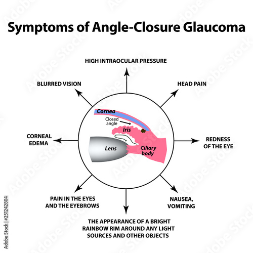 The symptoms of closed angle glaucoma. World glaucoma day. The anatomical structure of the eye. Infographics. Vector illustration on isolated background.