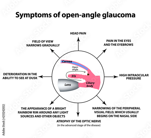 Symptoms of open-angle glaucoma. World glaucoma day. The anatomical structure of the eye. Infographics. Vector illustration on isolated background.
