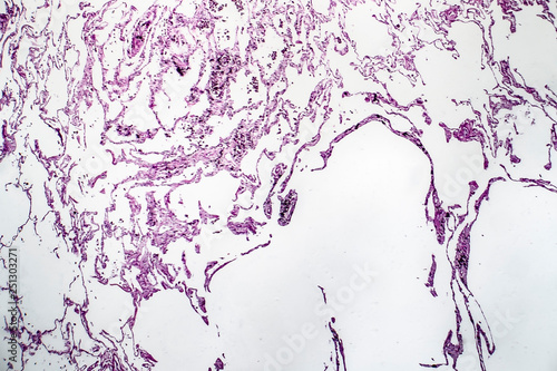 Canvas Print Histopathology of lung emphysema, light micrograph, photo under microscope showi