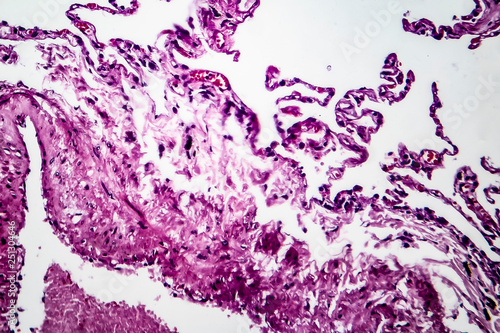 Histopathology of lung emphysema, light micrograph, photo under microscope showing enlargement of air spaces in lung tissue and destruction of alveolar septa photo