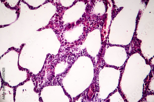 Histopathology of pneumonia, light micrograph, photo under microscope. Cellulose aspiration pneumonia