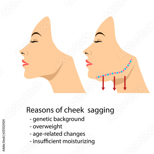 Face of a woman demonstrating aging changes in jaw angle