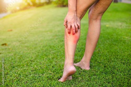 Quadro em tela Women with his feet, itching on the lawn caused by insect bites and stings/health and medical view and devising concepts