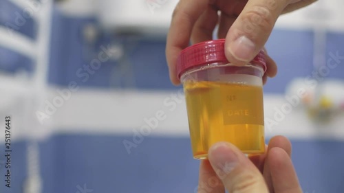 the technician's hand mixes the urine sample container and demonstrates the analysis container