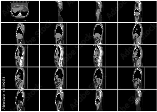 ct scan step set of body sagittal view photo