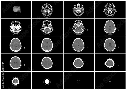 ct scan step set of upper brain head axial top view photo