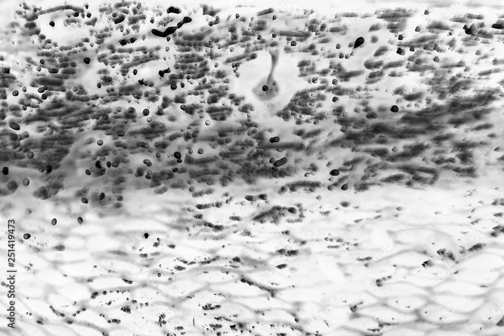 mammary cancer. cancer cells under a microscope. Tissues affected by