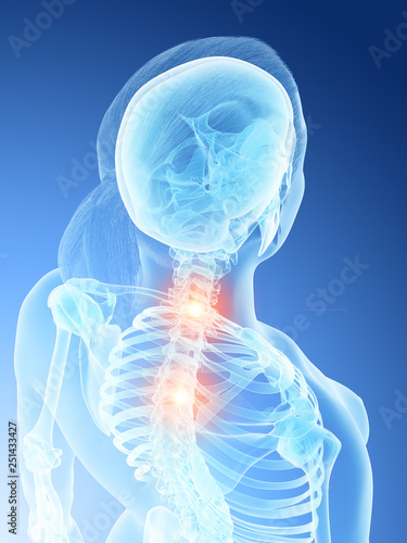 3d rendered illustration of a females painful neck