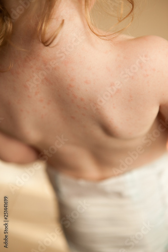 Little Girl with Skin Rash from Allergic Reaction to Amoxicillin - Health  Medicine  Skincare