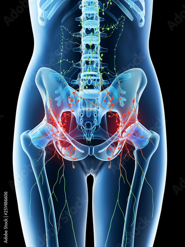 3d rendered illustration of a females inflamed abdominal lymph nodes