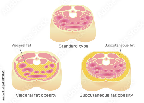 Type of obesity illustration. Abdominal sectional View. (visceral fat , subcutaneous fat)