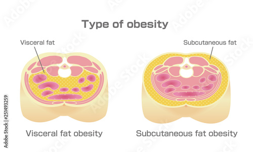 Type of obesity illustration. Abdominal sectional View. (visceral fat , subcutaneous fat)