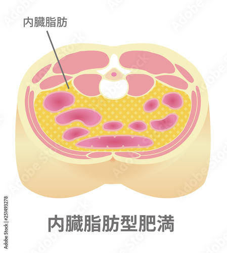 腹部断面図イラスト「肥満のタイプ」/ 内臓脂肪型肥満