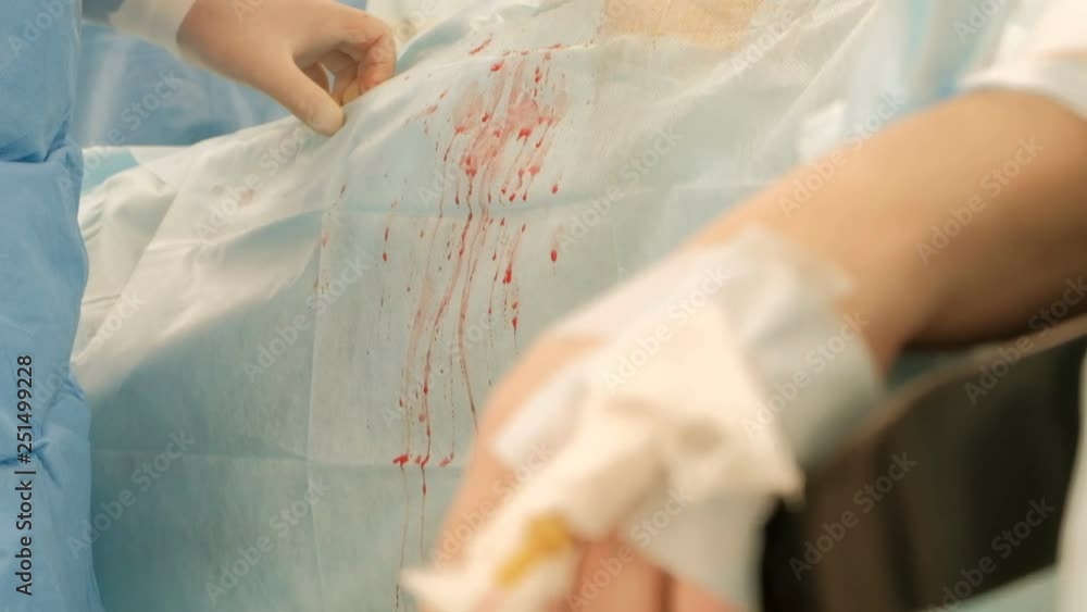 Operating room in the hospital. Endovideosurgery. The camera and point of focus moves from the hands of the surgeons to the arm of a fat female patient. Laparoscopic surgery. Closeup. Endo instruments Operating room in the hospital. Endovideosurgery. The camera and point of focus moves from the hands of the surgeons to the arm of a fat female patient. Laparoscopic surgery. Closeup. Endo instruments