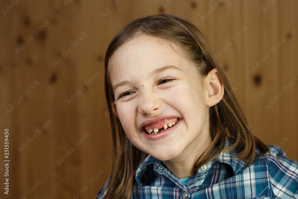 Child smiling, showing her missing milk teeth Child smiling, showing her missing milk teeth