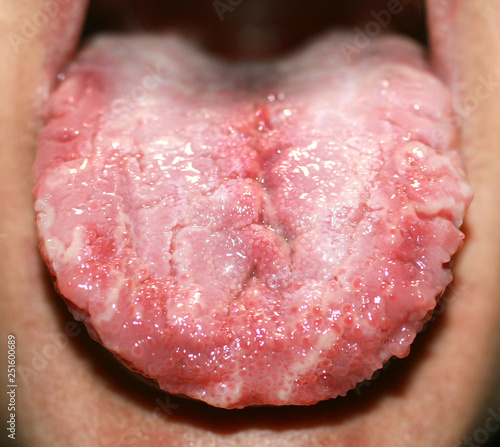 Geographic tongue, candidiasis, the language of the white coating candida photo