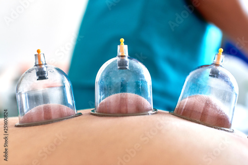 Healing bloodletting, hijama or phlebotomy. Hajam master conducts cupping therapy on a young woman. Islamic medicine photo