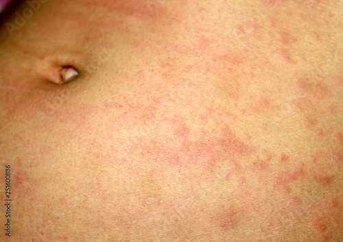 Pink lichen on the skin of the abdomen. Psoriasis, dermatitis, eczema, urticaria, allergies.