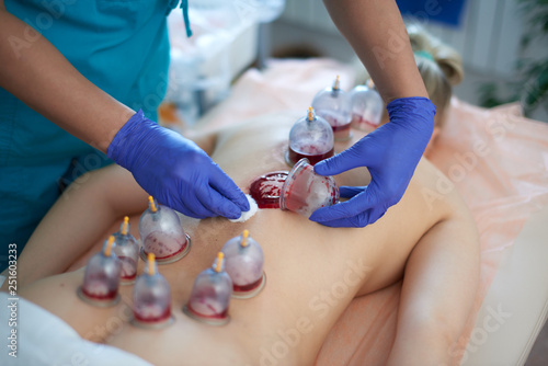 Fotografija Healing bloodletting, hijama or phlebotomy