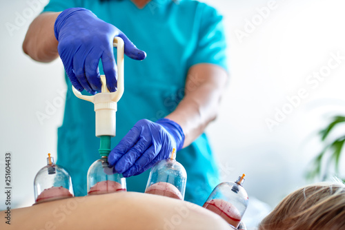 Fotografía Healing bloodletting, hijama or phlebotomy