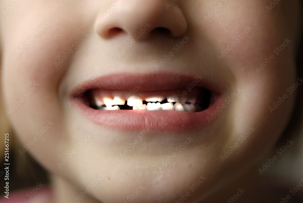 Little Kid Lost Teeth Empty Space Little Kid Lost Teeth Empty Space