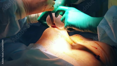 The introduction of the implant into the patient's chest during plastic surgery breast augmentation. The surgeon inserts under the skin a silicone implant of the female breast. Increases tits.