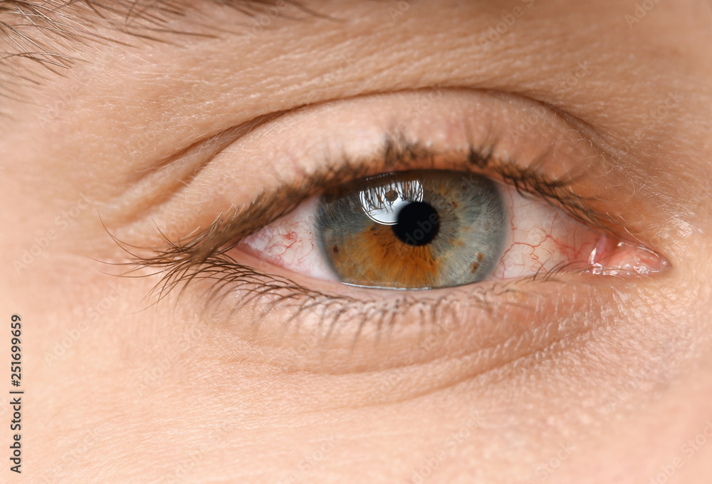 Young man suffering from allergy, closeup. Red eye Young man suffering from allergy, closeup. Red eye