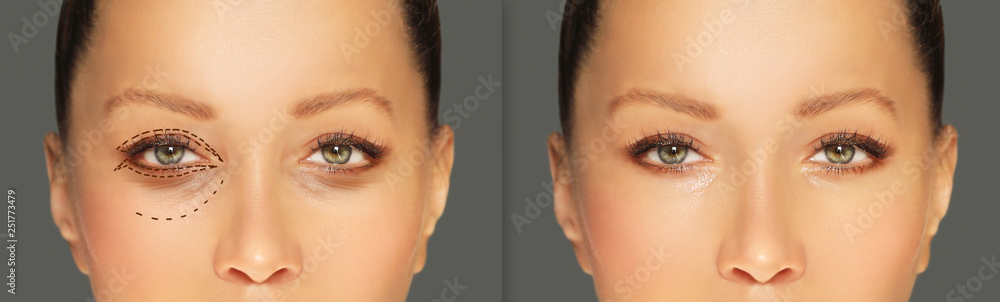 Lower and upper Blepharoplasty.Marking the face.Perforation lines on females face, plastic surgery concept. Lower and upper Blepharoplasty.Marking the face.Perforation lines on females face, plastic surgery concept.