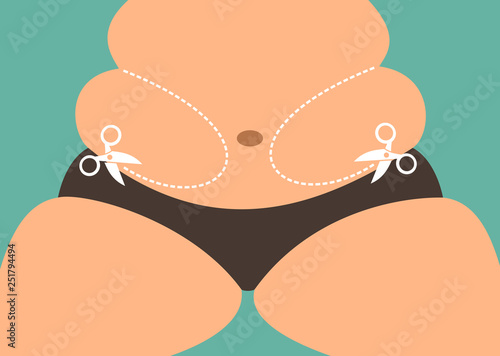 Liposuction and fat reduction - overweight fatty person with belly fat is going to have aesthetic surgery  to lose weight. Vector illustration