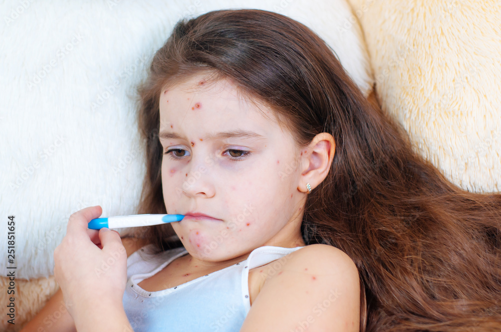 Closeup of cute sad little girl. Varicella virus or Chickenpox bubble rash on child Closeup of cute sad little girl. Varicella virus or Chickenpox bubble rash on child